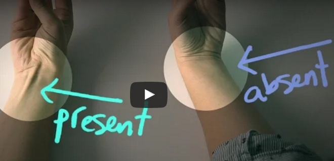 Спојте ги палецот и малиот прст – еве што значи ако ви се појави оваа испакнина